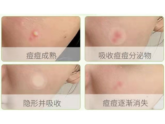 一次性使用無菌敷貼（痘痘貼）